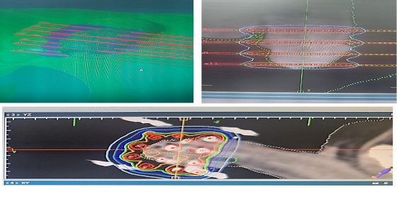 Oncorad Group تنشر أول بحث علمي مغربي حول العلاج الإشعاعي الداخلي لسرطان الغدة في مجلة طبية أمريكية
